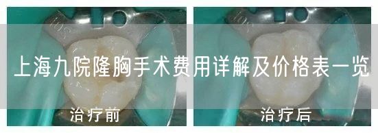 上海九院隆胸手术费用详解及价格表一览