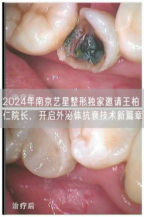 2024年南京艺星整形独家邀请王柏仁院长，开启外泌体抗衰技术新篇章