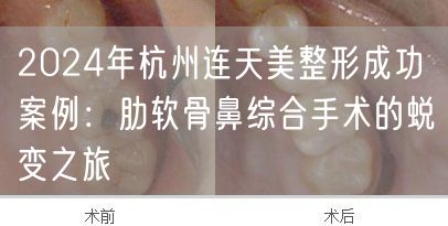 2024年杭州连天美整形成功案例：肋软骨鼻综合手术的蜕变之旅