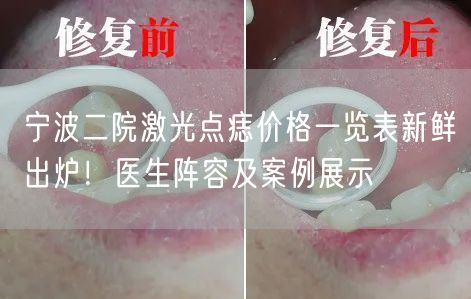 宁波二院激光点痣价格一览表新鲜出炉！医生阵容及案例展示