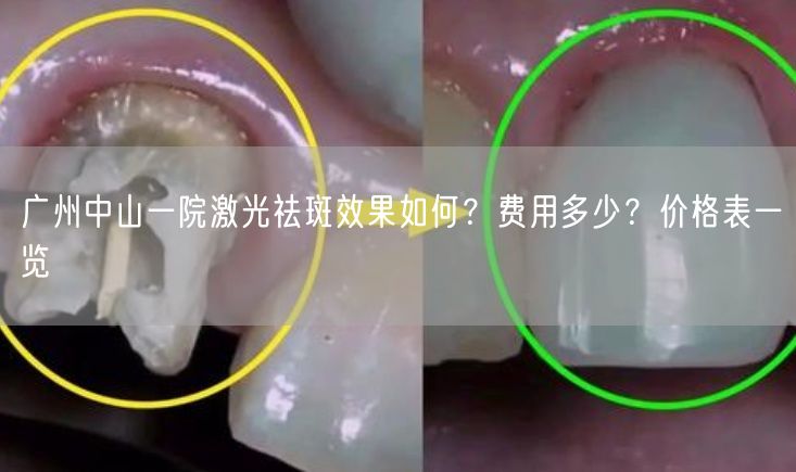 广州中山一院激光祛斑效果如何？费用多少？价格表一览