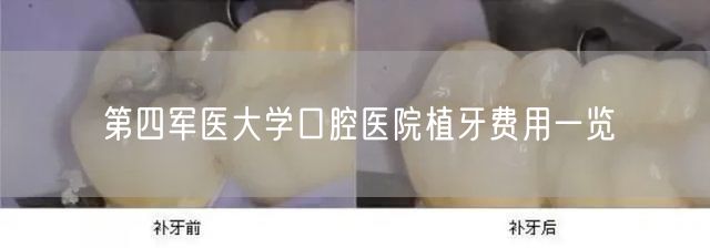 第四军医大学口腔医院植牙费用一览