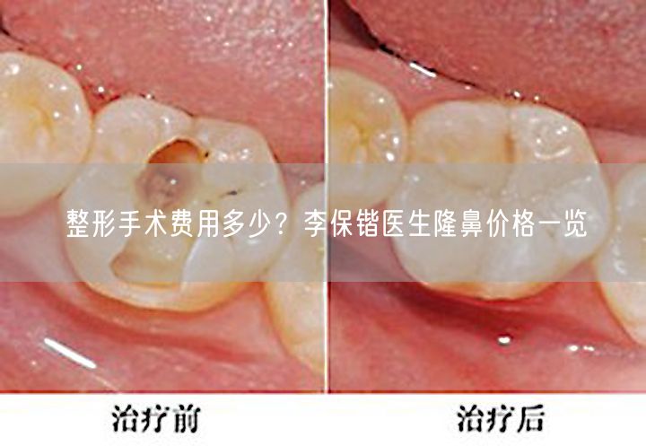 整形手术费用多少？李保锴医生隆鼻价格一览
