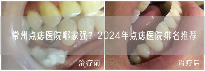 常州点痣医院哪家强？2024年点痣医院排名推荐