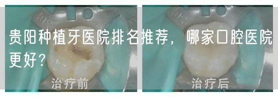 贵阳种植牙医院排名推荐，哪家口腔医院更好？
