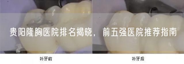 贵阳隆胸医院排名揭晓，前五强医院推荐指南