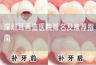 深圳耳再造医院排名及推荐指南