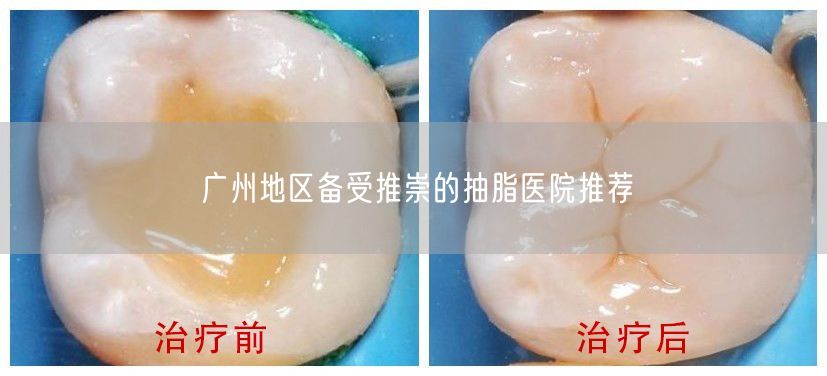 广州地区备受推崇的抽脂医院推荐