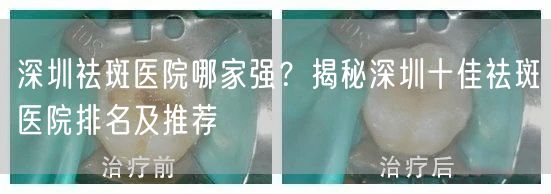 深圳祛斑医院哪家强？揭秘深圳十佳祛斑医院排名及推荐