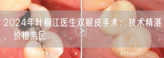 2024年叶桐江医生双眼皮手术：技术精湛，价格亲民