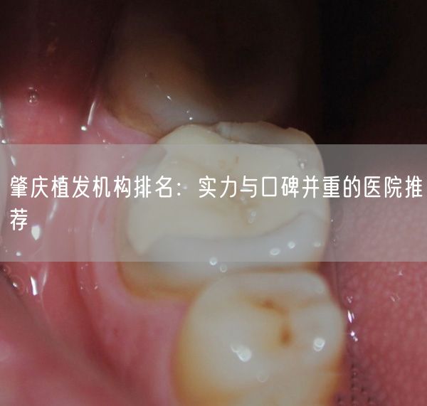 肇庆植发机构排名：实力与口碑并重的医院推荐