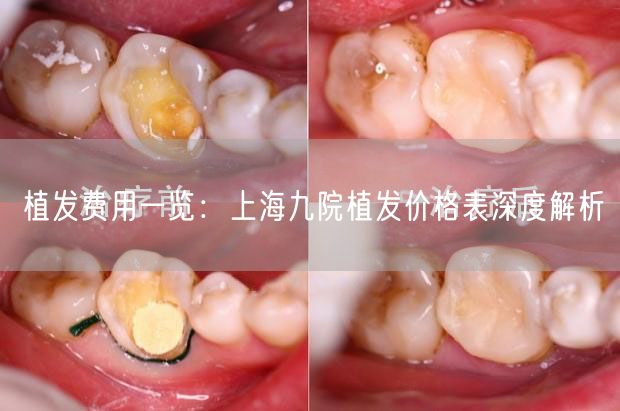 植发费用一览：上海九院植发价格表深度解析