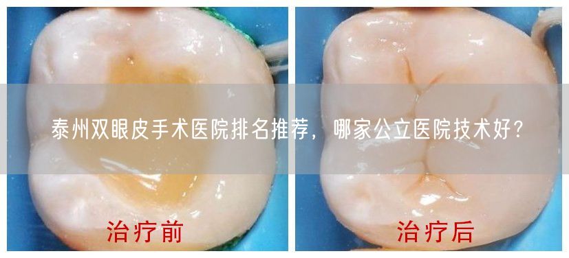 泰州双眼皮手术医院排名推荐，哪家公立医院技术好？