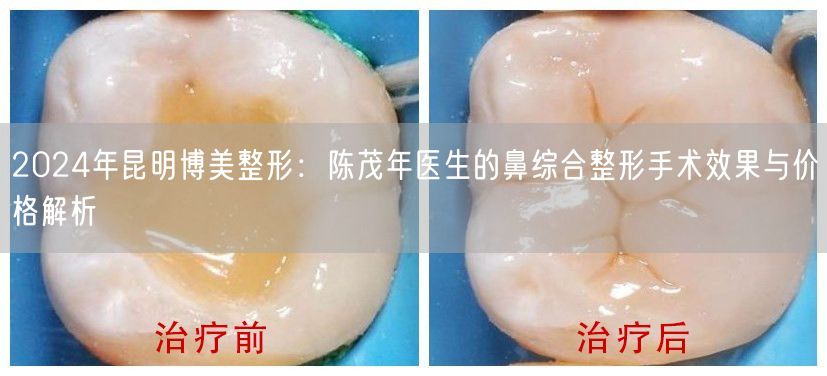 2024年昆明博美整形：陈茂年医生的鼻综合整形手术效果与价格解析