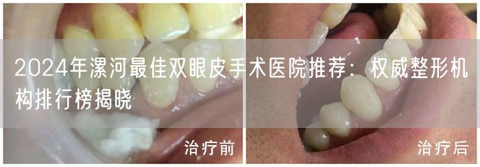 2024年漯河最佳双眼皮手术医院推荐：权威整形机构排行榜揭晓