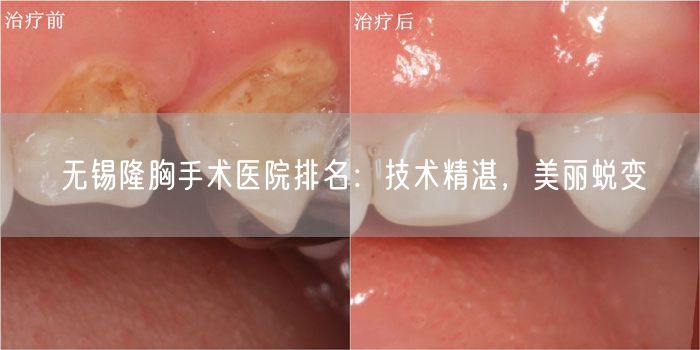 无锡隆胸手术医院排名：技术精湛，美丽蜕变