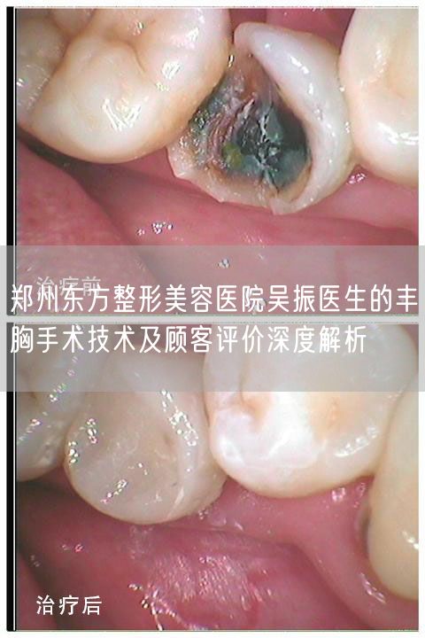 郑州东方整形美容医院吴振医生的丰胸手术技术及顾客评价深度解析