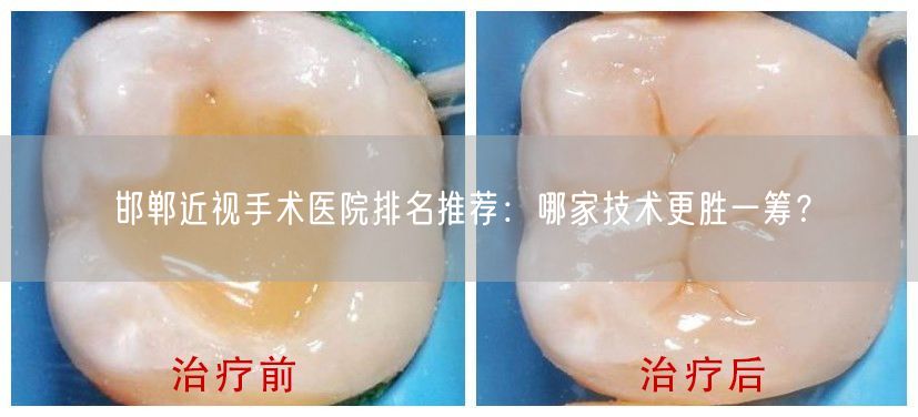 邯郸近视手术医院排名推荐：哪家技术更胜一筹？