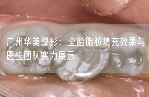 广州华美整形：全脸脂肪填充效果与医生团队实力展示