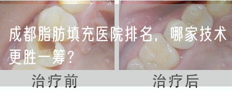 成都脂肪填充医院排名，哪家技术更胜一筹？