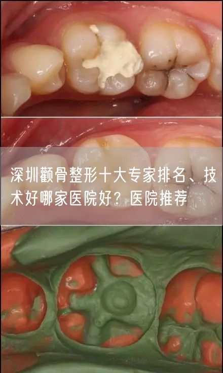 深圳颧骨整形十大专家排名、技术好哪家医院好？医院推荐