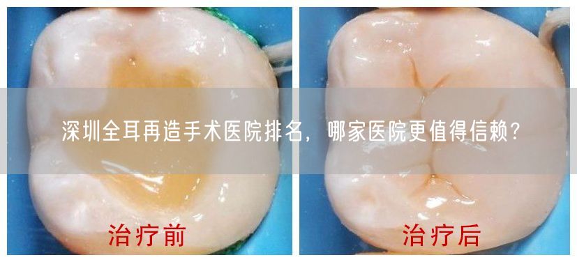 深圳全耳再造手术医院排名，哪家医院更值得信赖？
