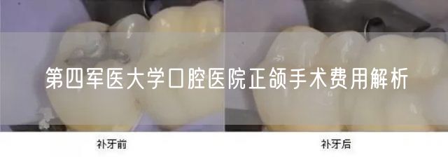 第四军医大学口腔医院正颌手术费用解析