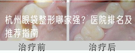 杭州眼袋整形哪家强？医院排名及推荐指南
