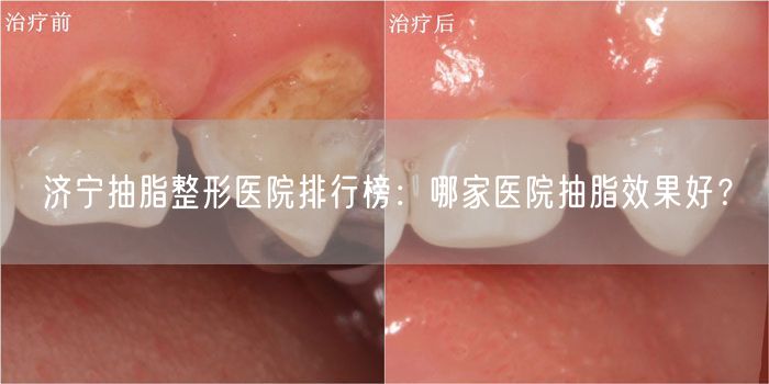 济宁抽脂整形医院排行榜：哪家医院抽脂效果好？