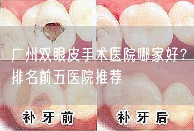 广州双眼皮手术医院哪家好？排名前五医院推荐
