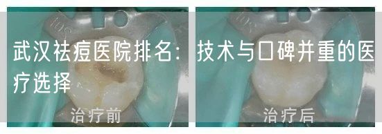 武汉祛痘医院排名：技术与口碑并重的医疗选择