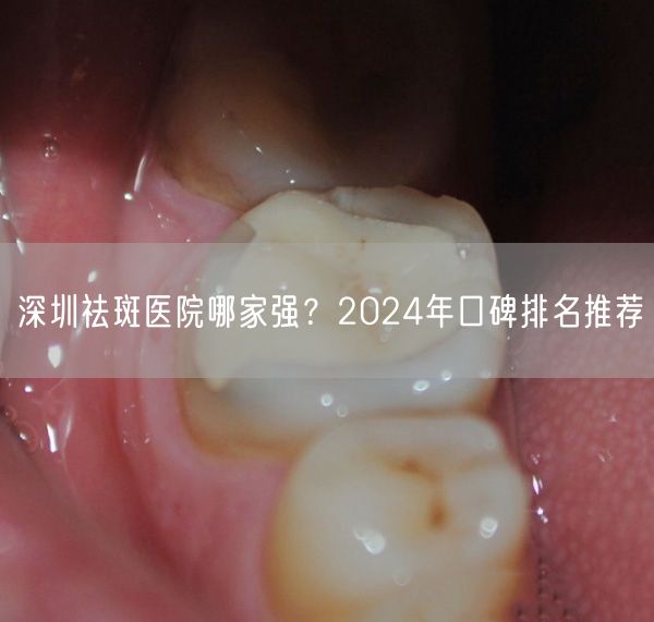 深圳祛斑医院哪家强？2024年口碑排名推荐