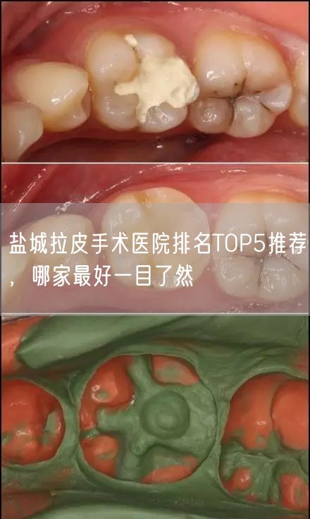 盐城拉皮手术医院排名TOP5推荐，哪家最好一目了然