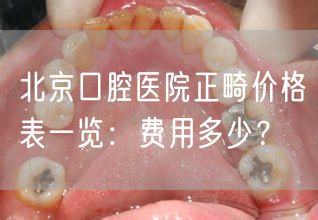 北京口腔医院正畸价格表一览：费用多少？