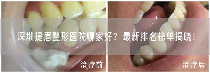 深圳提眉整形医院哪家好？最新排名榜单揭晓！