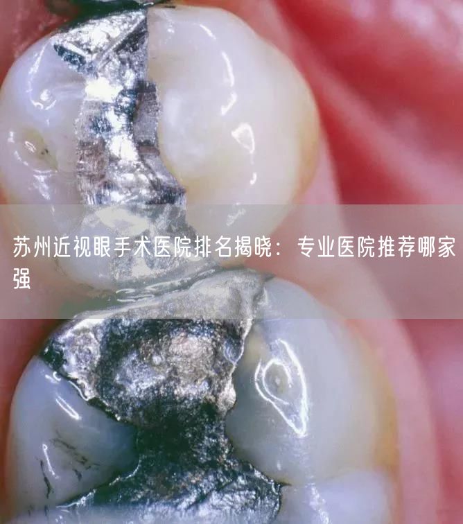 苏州近视眼手术医院排名揭晓：专业医院推荐哪家强