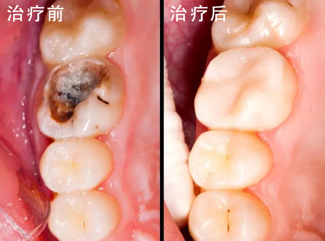 智齿发炎怎么办,化疗后智齿发炎怎么办(图1)