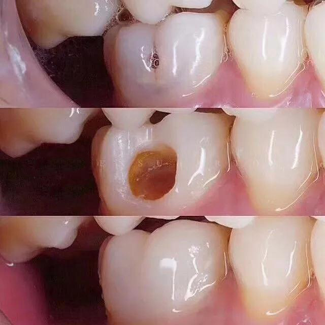 牙齿疼怎么办—补牙齿后牙齿疼怎么办