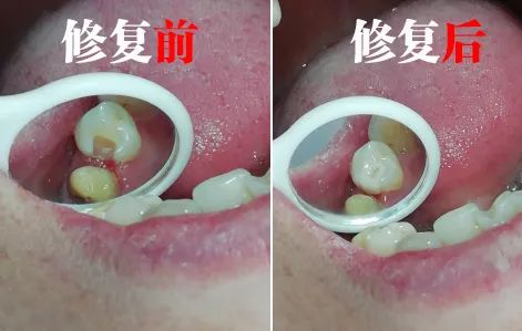 牙齿疼怎么快速止疼-牙齿疼怎么快速止疼吃什么药(图1)
