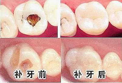 智齿发炎肿痛怎么办,智齿发炎肿痛怎么办,吞口水喉咙都痛