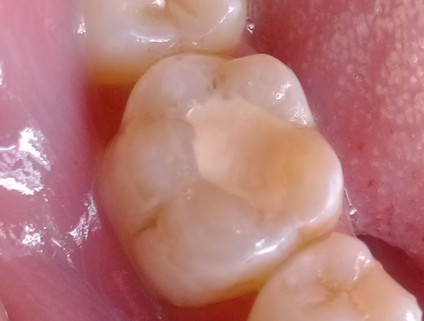 口腔溃疡怎么缓解、口腔溃疡怎么缓解疼痛(图1)