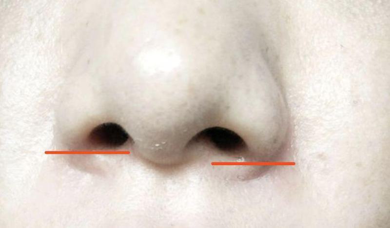 成都娇点李竞隆鼻怎么样？有真实案例反馈可参考，风格自然不显假