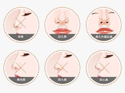 福州弗丽嘉美容医院做隆鼻好吗？福州弗丽嘉隆鼻费用+