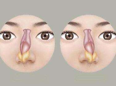 成都仪美美仁周仪做隆鼻修复技术怎么样？附真实案例精选