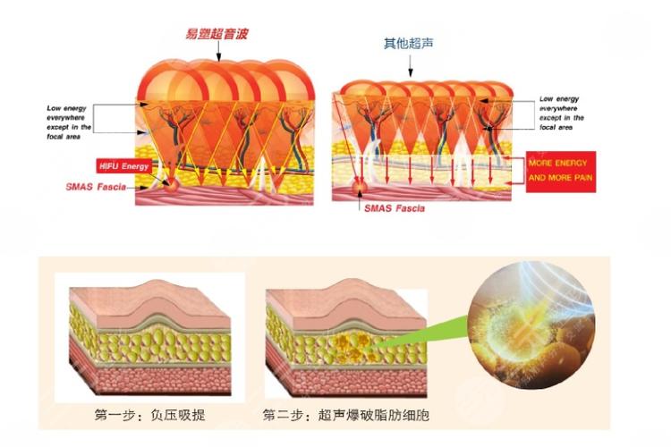 深圳南雅吸脂怎么样？何奇医生的超脂塑技术评价高价格合理