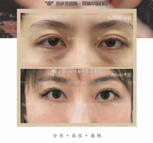 欧洲之星fotona4d下颌缘提升效果好不好，欧洲