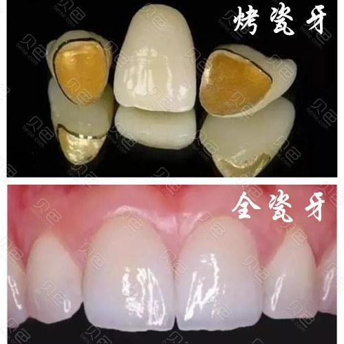 1000元的全瓷牙和1500的区别什么？有什么不同？