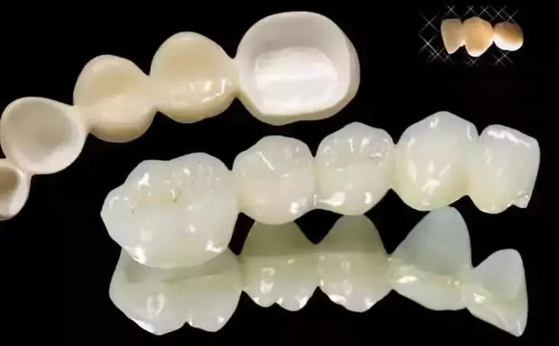 贵金属烤瓷牙和全瓷牙哪个硬度高？全瓷牙价格影响因素介绍