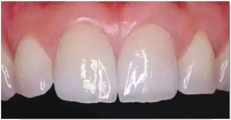 美维特全瓷牙多少钱一颗？哪些因素影响美维特全瓷牙的价格？真人术后体验反馈！(图1)