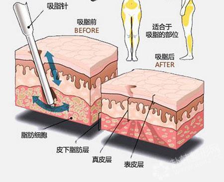 艾尔莎奥拉克医疗美容医院怎么样？杭州艾尔莎奥拉克医疗美容医院吸脂费用？